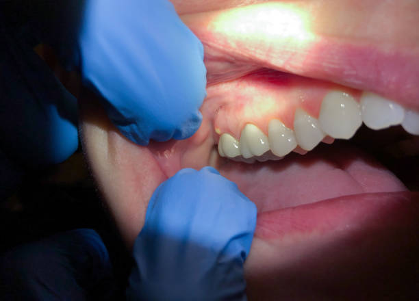 Best Emergency Root Canal Treatment in Rockville, CT